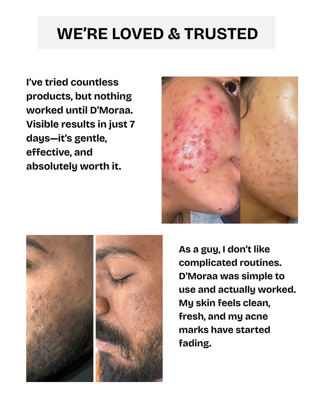 Acne & Scar Treatment Serum | All Skin Type - 30ml