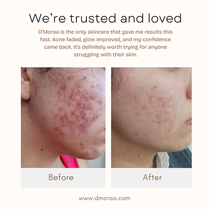 Acne & Scar Treatment Serum | All Skin Type - 30ml