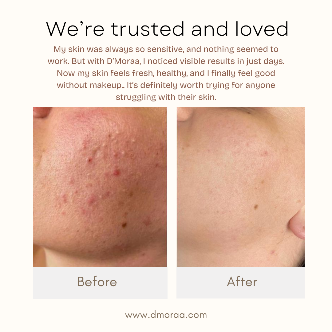 Acne & Scar Treatment Serum | All Skin Type - 30ml