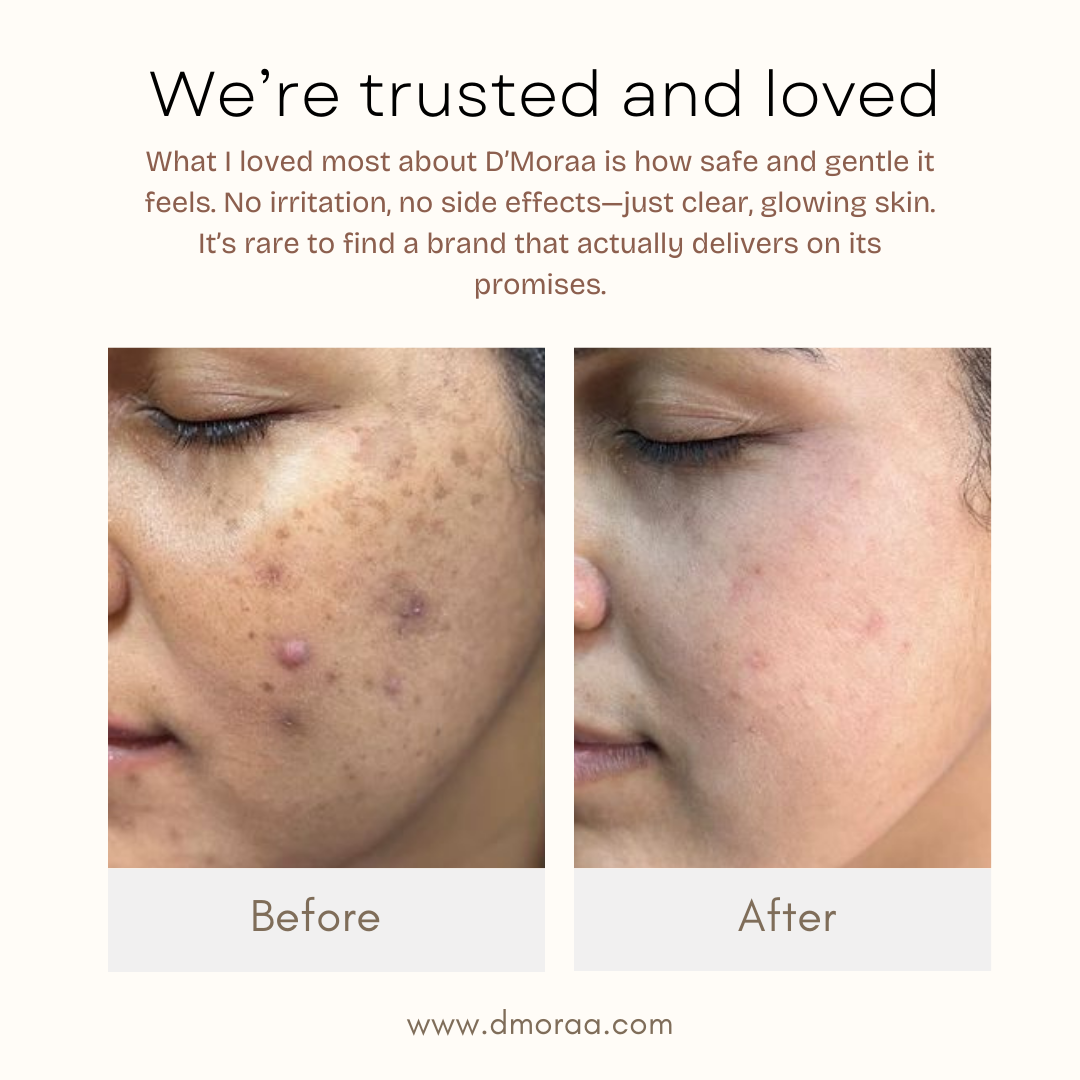 Acne & Scar Treatment Serum | All Skin Type - 30ml