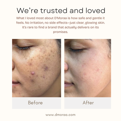 Acne & Scar Treatment Serum | All Skin Type - 30ml