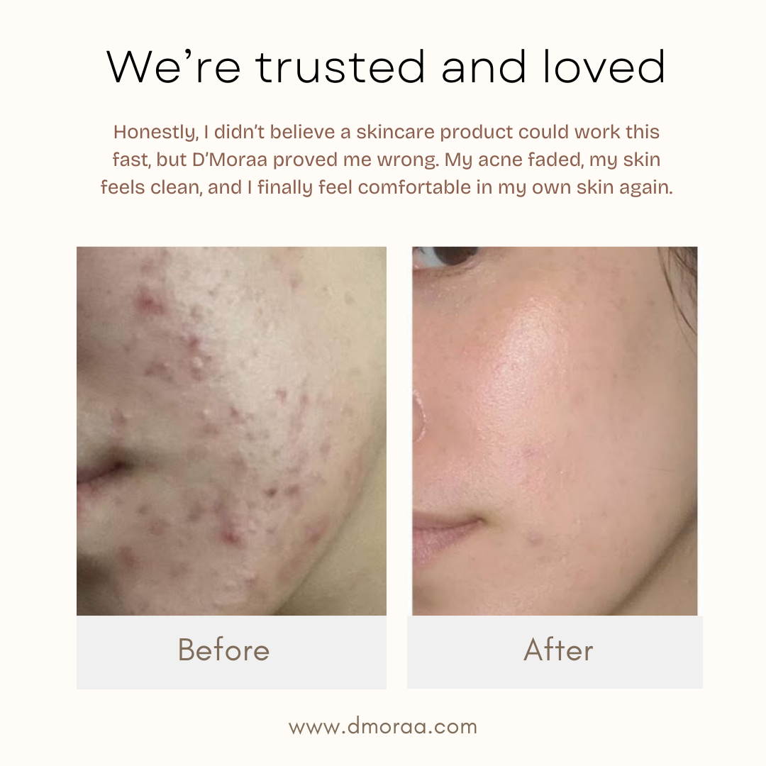 Acne & Scar Treatment Serum | All Skin Type - 30ml