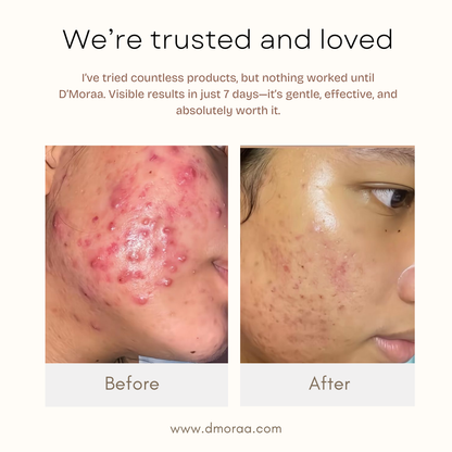 Acne & Scar Treatment Serum | All Skin Type - 30ml