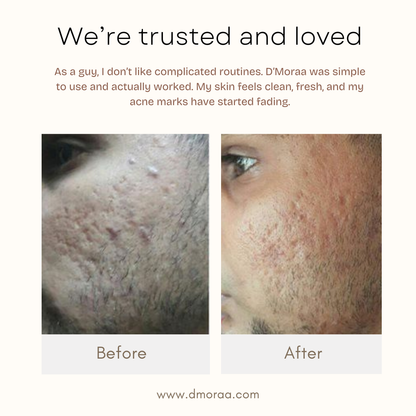 Acne & Scar Treatment Serum | All Skin Type - 30ml