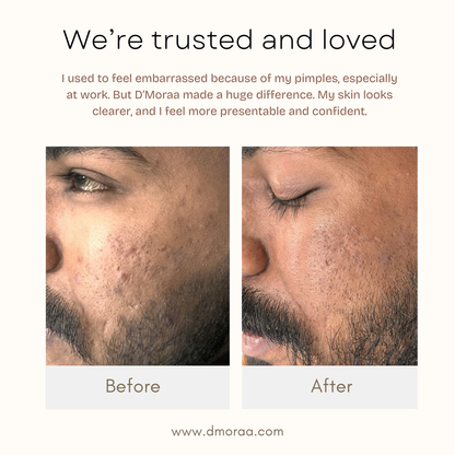 Acne & Scar Treatment Serum | All Skin Type - 30ml