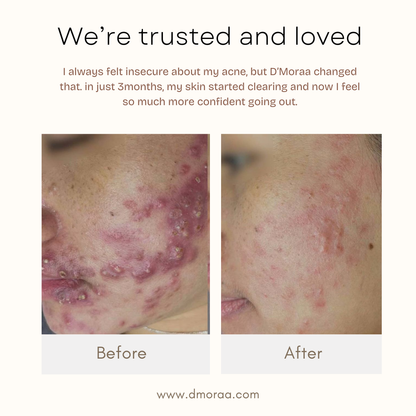 Acne & Scar Treatment Serum | All Skin Type - 30ml