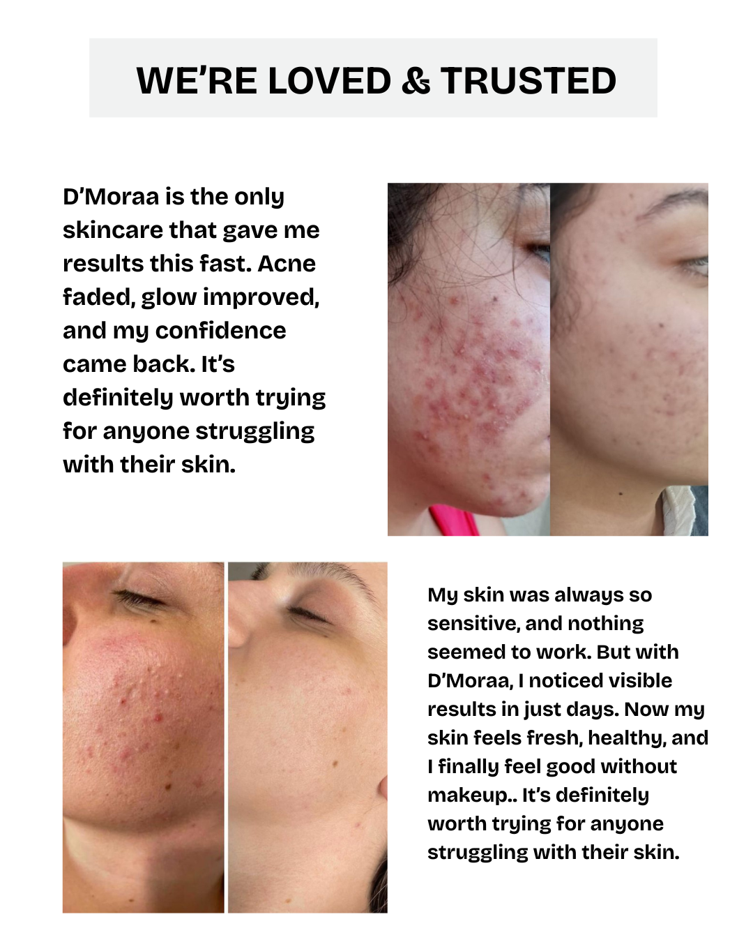 Acne & Scar Treatment Serum | All Skin Type - 30ml